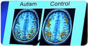 how autistic traits in children impact their brains